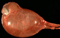 Hydrocele
